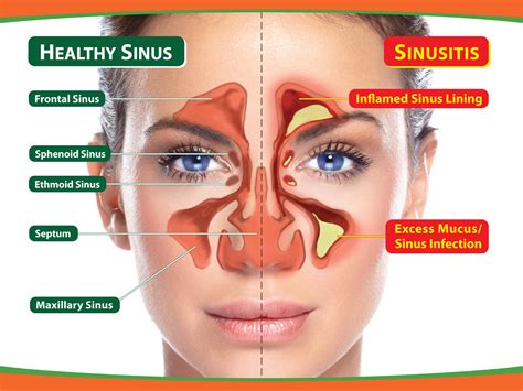 Sinus infection causes, symptoms and natural treatments for sinusitis