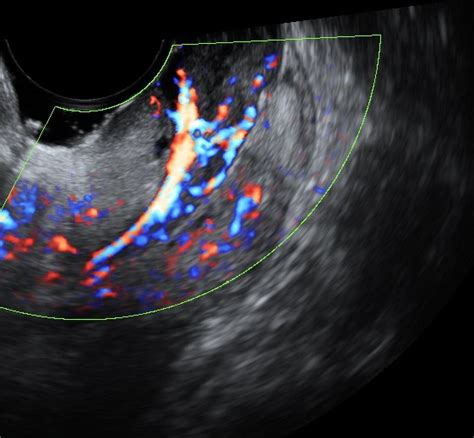 Cervical Polyp On Ultrasound