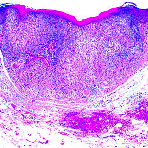 trichilemmomas - pictures, photos