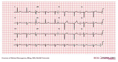 First degree AV block EKG examples - wikidoc