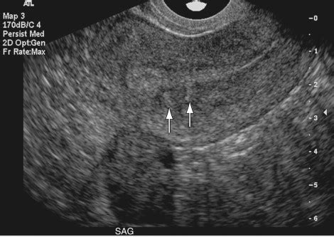 Adenomyosis | Radiology Key