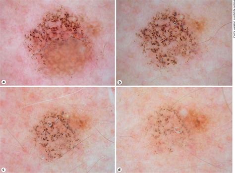 Figure 3 from Studying Regression of Seborrheic Keratosis in Lichenoid ...