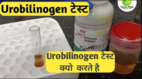 urobilinogen test - YouTube