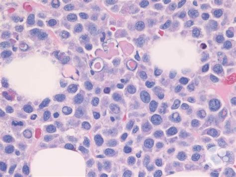 Dutcher bodies in myeloma