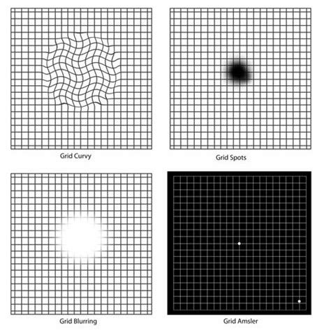 Macular Degeneration | Sunnyside Queens Eye Doctor