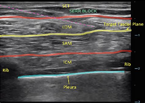 Anterior Plane