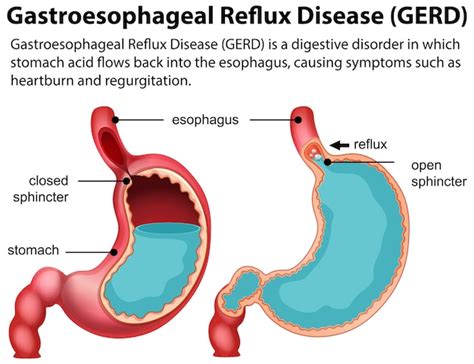 Free Vector | Gastroesophageal Reflux Disease GERD Diagram