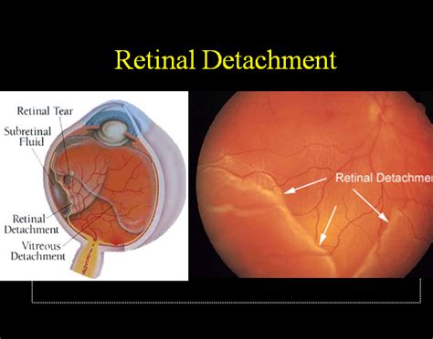 Retinal Detachment:Types,Causes,Symptoms & Treatment » How To Relief