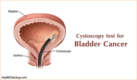 Cystoscopy Test for Bladder Cancer | What is Cystoscopy?