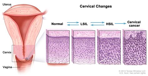 How Long Does Cervical Cancer Take To Develop