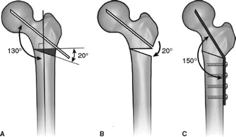 Femoral Head Osteotomy Cat