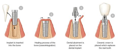 Complete Dental Implant Surgery Guide - What to Expect