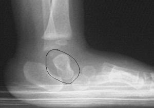 What does congenital vertical talus deformity mean? | Podiatry FAQ's