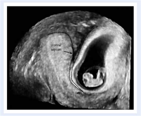 Figure 1 from The pregnancy outcome in women with incidental diagnosis ...