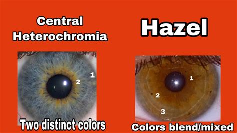 Central heterochromia vs hazel eyes difference | Central heterochromia ...