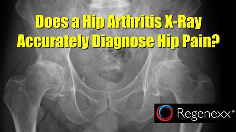 Hip Arthritis X-Ray Not Associated with Pain? - Regenexx®