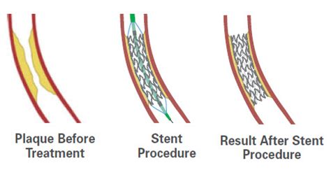 How coronary stents work - Boston Scientific