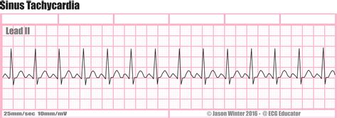 ECG Educator Blog : Sinus Tachycardia