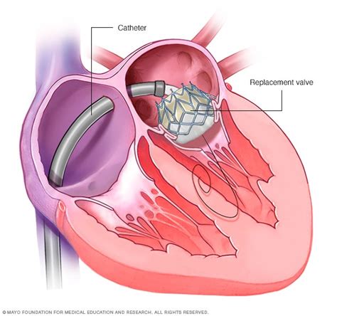 Transcatheter mitral valve replacement - Mayo Clinic