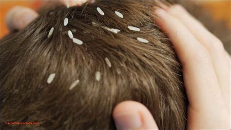 Head Lice Eggs In Hair - Caraway Seeds Health Benefits