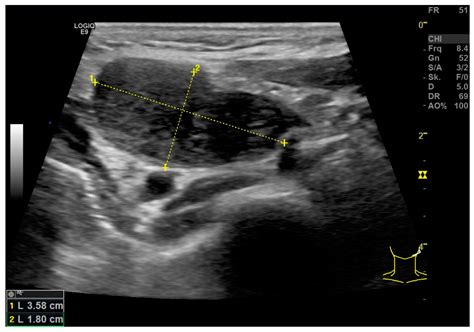 Cervix Ultrasound Labeled