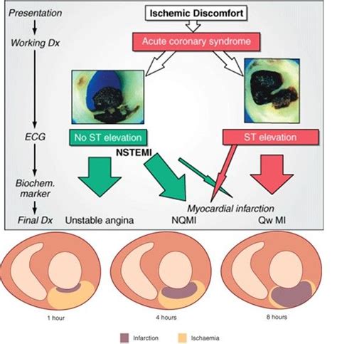 Difference between NSTEMI and STEMI | Medical school studying, Emt ...