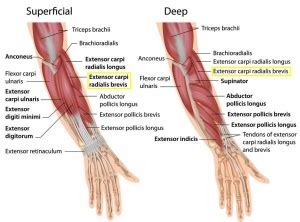 Lateral Epicondylitis - Physiopedia