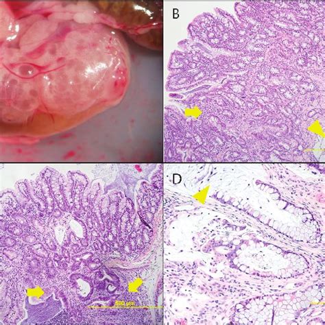 Appearance of mucinous adenocarcinoma in situ ; outlined (A) and MRI ...