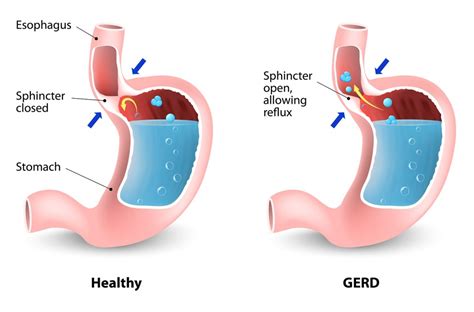 Esophageal Cancer, GERD, and Veterans: Here's Everything That We Know!