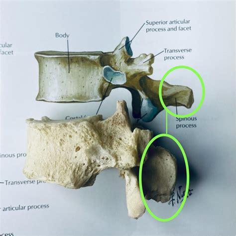 Netters T12 vertebrae vs real T12 vertebrae. You can see natural ...