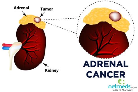 Adrenal Gland Tumor Symptoms