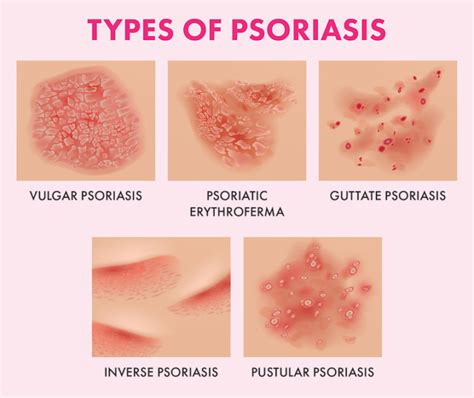 The Ultimate Guide To Psoriasis: What Causes It And How To Treat It ...