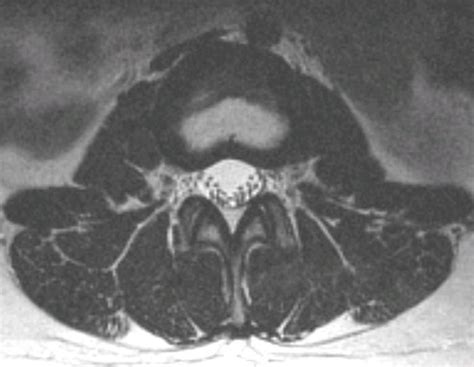 Axial Lumbar Anatomy