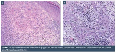 A Rare Case of Trichilemmal Carcinoma: Histology and Management | JCAD ...