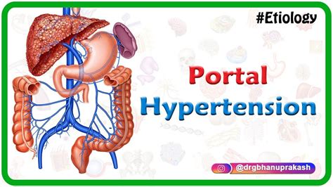 Causes Of Young Hypertension - Hypertension - NASM - Check spelling or ...