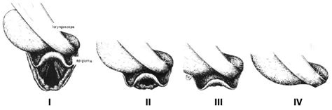 Nerdfallmedizin.de - cormack-lehane-scoring-system-laryncoscopy