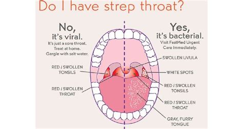 Strep No Fever