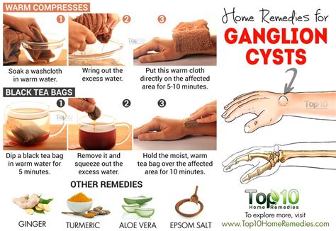 How To Get Rid Of A Ganglion Cyst Without Surgery - Brandon Martin Kapsels