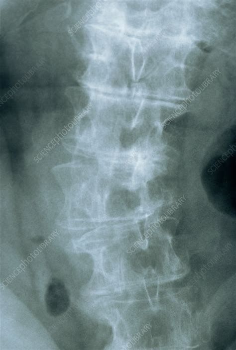 Osteoarthritis of the spine, X-ray - Stock Image - M110/0522 - Science ...