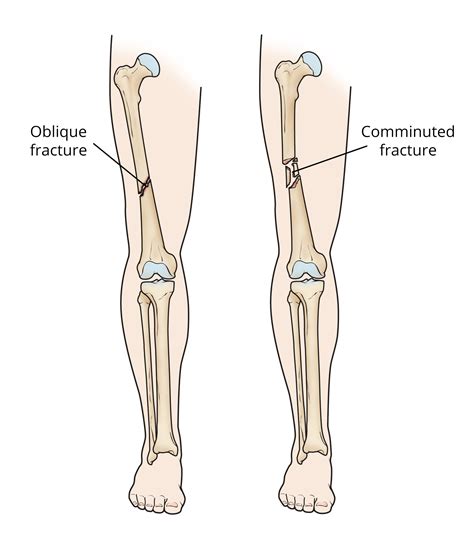 Femur Shaft Fractures (Broken Thighbone) | Iranian Surgery