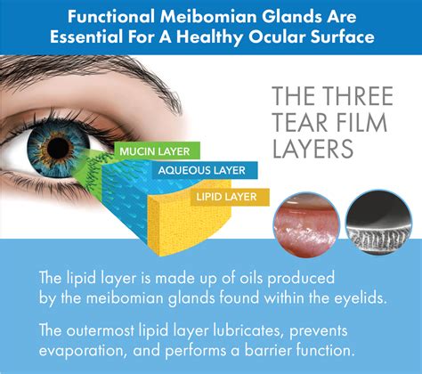 Most dry eye syndromepatients have meibomian gland dysfunction - Dr. M ...