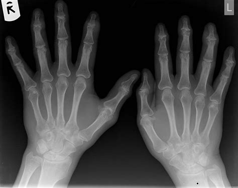 Psoriatic arthritis x ray - wikidoc