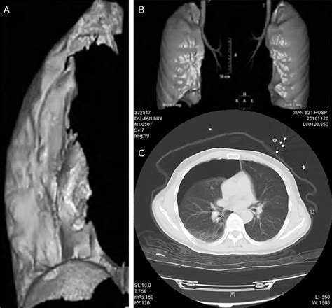 Figure 1 from Diagnostic value of multi-slice spiral CT scan in lung ...