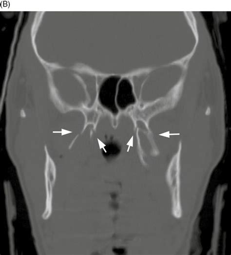 Pterygoid Plate Fracture