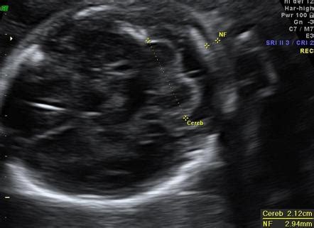 Nuchal fold | Radiology Reference Article | Radiopaedia.org