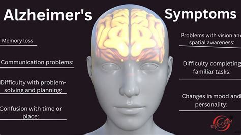 Alzheimer's disease - Top Pharmaceutical Wholesaler Exporter