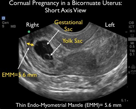 Ultrasound Leadership Academy: Ultrasound in Early Pregnancy — EM Curious