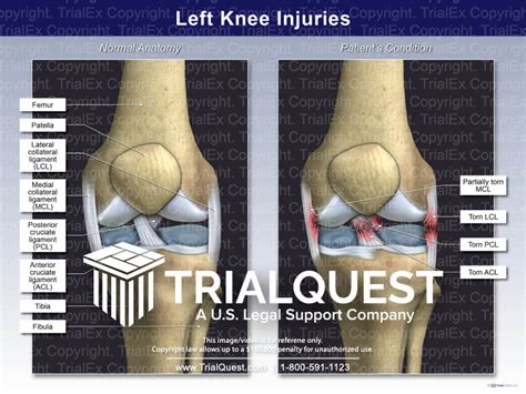 Left Knee Injuries - TrialQuest Inc.