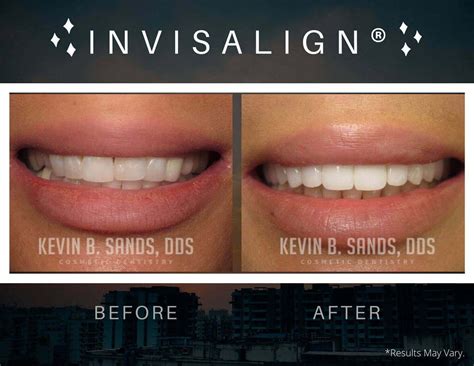 Invisalign®: The Next Evolution of Braces | Dr. Kevin Sands