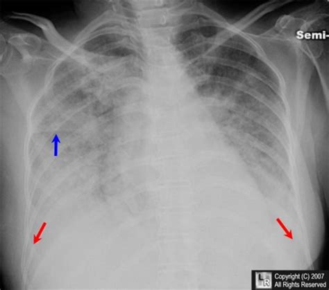 Learning Radiology - Congestive Heart Failure, Pulmonary Edema